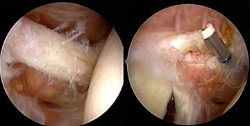 Arthroskopische Bicpessehnentenotomie