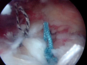 Endoskopische Supraspinatussehennaht