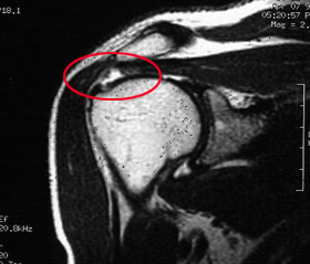 MRT einer Rotatorenmanschettenruptur
